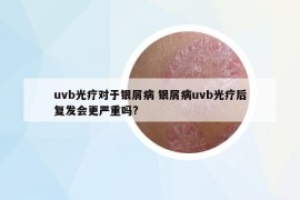 uvb光疗对于银屑病 银屑病uvb光疗后复发会更严重吗?