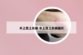 手上臂上长癣 手上臂上长癣图片