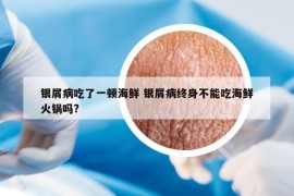 银屑病吃了一顿海鲜 银屑病终身不能吃海鲜火锅吗?
