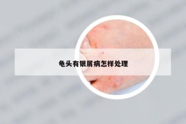 龟头有银屑病怎样处理