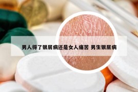 男人得了银屑病还是女人痛苦 男生银屑病