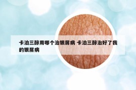 卡泊三醇用哪个治银屑病 卡泊三醇治好了我的银屑病