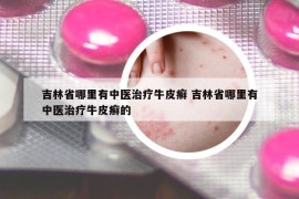 吉林省哪里有中医治疗牛皮癣 吉林省哪里有中医治疗牛皮癣的
