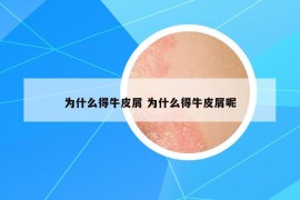 为什么得牛皮屑 为什么得牛皮屑呢