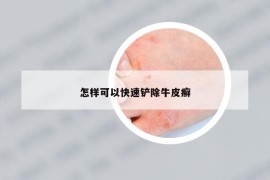 怎样可以快速铲除牛皮癣