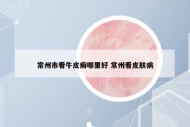 常州市看牛皮癣哪里好 常州看皮肤病
