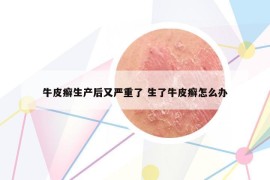 牛皮癣生产后又严重了 生了牛皮癣怎么办