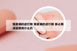 银屑病的进行期 银屑病的进行期 静止期 消退期用什么药