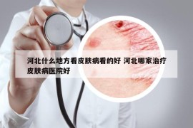 河北什么地方看皮肤病看的好 河北哪家治疗皮肤病医院好