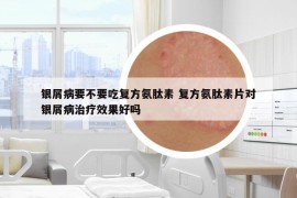 银屑病要不要吃复方氨肽素 复方氨肽素片对银屑病治疗效果好吗
