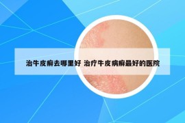 治牛皮癣去哪里好 治疗牛皮病癣最好的医院