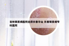 吉林银屑病医院选择长春华山 长春银屑病专科医院