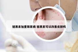 褪黑素加重银屑病 褪黑素可以改善皮肤吗