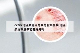 cctv2泡温泉能治是真是假银屑病 泡温泉治银屑病能有好处吗