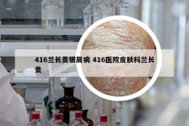 416兰长贵银屑病 416医院皮肤科兰长贵