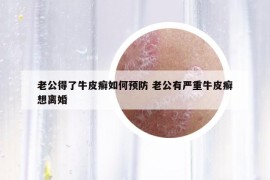 老公得了牛皮癣如何预防 老公有严重牛皮癣想离婚