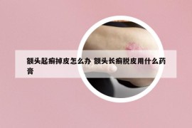 额头起癣掉皮怎么办 额头长癣脱皮用什么药膏
