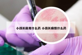 小孩长藓用什么药 小孩长癣擦什么药