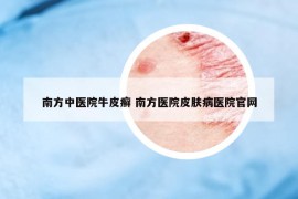 南方中医院牛皮癣 南方医院皮肤病医院官网