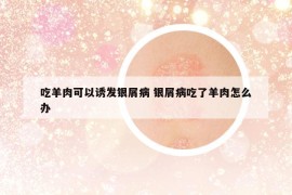 吃羊肉可以诱发银屑病 银屑病吃了羊肉怎么办