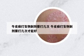 牛皮癣打生物制剂要打几次 牛皮癣打生物制剂要打几次才能好