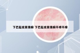 下巴起皮屑像癣 下巴起皮屑像癣不疼不痒