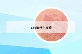 159治疗牛皮癣