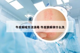 牛皮癣啥方法消毒 牛皮肤癣拿什么洗