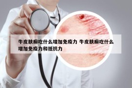 牛皮肤癣吃什么增加免疫力 牛皮肤癣吃什么增加免疫力和抵抗力