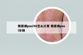 银屑病pasi90怎么计算 银屑病pasi分级