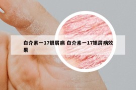 白介素一17银屑病 白介素一17银屑病效果
