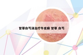 甘草白芍汤治疗牛皮癣 甘草 白芍