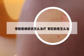 掌脓疱病症状怎么治疗 掌跎脓疱怎么治