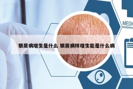 银屑病增生是什么 银屑病样增生能是什么病