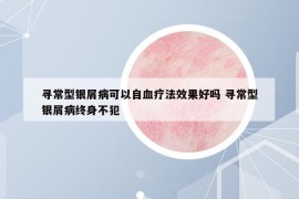 寻常型银屑病可以自血疗法效果好吗 寻常型银屑病终身不犯