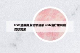 UVB进展期点滴银屑病 uvb治疗银屑病皮肤变黑