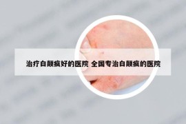 治疗白颠疯好的医院 全国专治白颠疯的医院