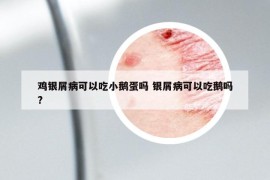 鸡银屑病可以吃小鹅蛋吗 银屑病可以吃鹅吗?