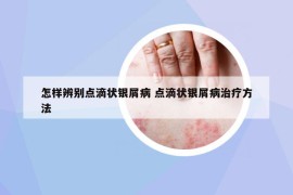 怎样辨别点滴状银屑病 点滴状银屑病治疗方法