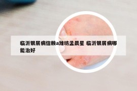 临沂银屑病信赖a潍坊孟晨星 临沂银屑病哪能治好