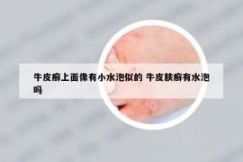 牛皮癣上面像有小水泡似的 牛皮肤癣有水泡吗