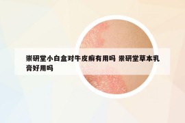 崇研堂小白盒对牛皮癣有用吗 祟研堂草本乳膏好用吗