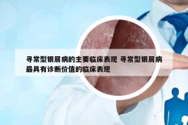 寻常型银屑病的主要临床表现 寻常型银屑病最具有诊断价值的临床表现