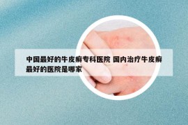 中国最好的牛皮癣专科医院 国内治疗牛皮癣最好的医院是哪家