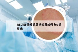 RELIEF治疗银屑病效果如何 leo银屑病