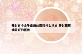 开封有个冶牛皮癣的医院什么地方 开封银屑病最好的医院