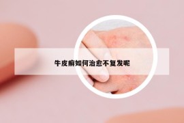 牛皮癣如何治愈不复发呢