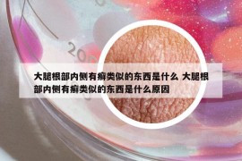大腿根部内侧有癣类似的东西是什么 大腿根部内侧有癣类似的东西是什么原因