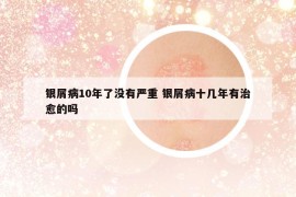 银屑病10年了没有严重 银屑病十几年有治愈的吗