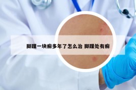 脚踝一块癣多年了怎么治 脚踝处有癣